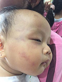 Phản hồi vụ trẻ bị bầm tím mặt ở Nhóm trẻ Hương Trang: Cơ sở phải ý thức trong việc chăm sóc trẻ
