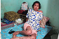 Gần 50 triệu đồng giúp chị Ngọc Vân bị bệnh vẩy nến