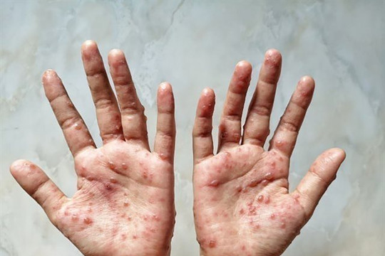 Monkeypox prevention control must be “one step ahead, one level higher”: Government