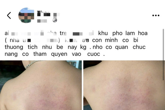 Vụ trẻ có dấu hiệu bị bạo hành: Đình chỉ hoạt động của nhà trẻ H.M