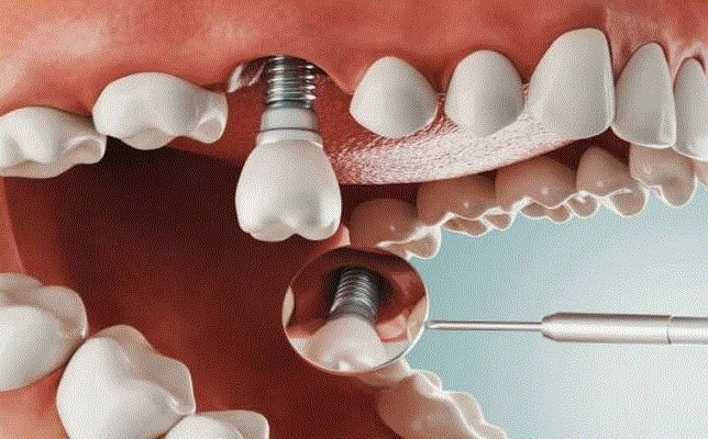 ‏Trồng răng Implant chuẩn y khoa tại Bệnh viện Răng Hàm Mặt Sài Gòn ‏