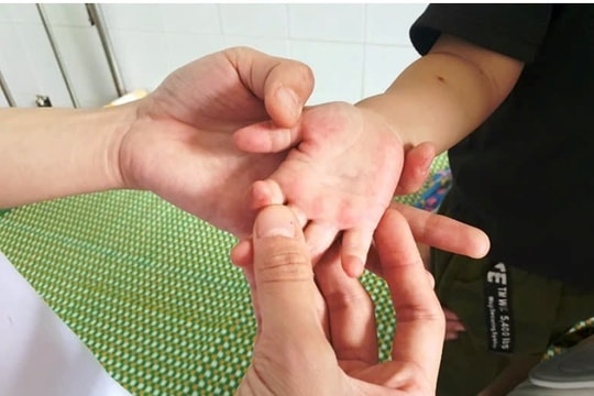 Gia đình, trường học chung tay phòng bệnh tay chân miệng